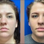 Everything You Need to Know About Buccal Fat Removal in NYC