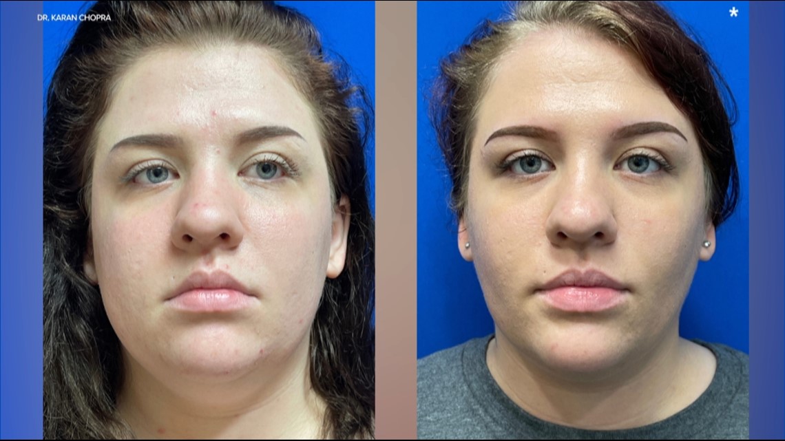 Everything You Need to Know About Buccal Fat Removal in NYC