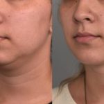 Chin Liposuction in NYC: Sculpt Your Face to Perfection